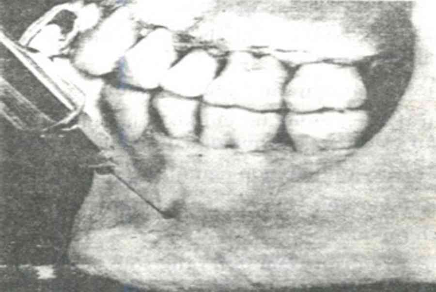 Gây tê vùng khi nhổ răng | Răng hàm mặt